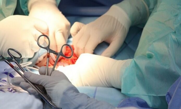 Συνδεσμοτομή – χειρουργική επέμβαση για τη μεγέθυνση του πέους