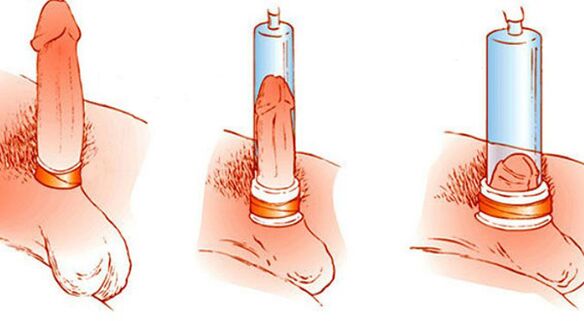 Η αρχή λειτουργίας μιας αντλίας κενού που μπορεί να μεγεθύνει το πέος